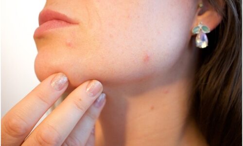 How to Identify Warts, Moles & Skin Tags