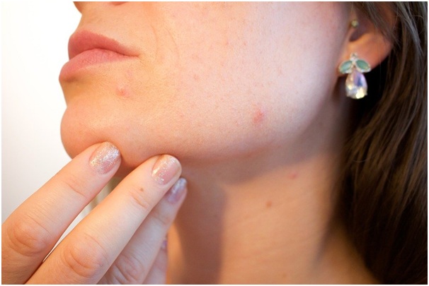 How to Identify Warts, Moles & Skin Tags